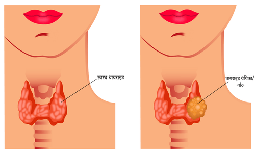 thyroid