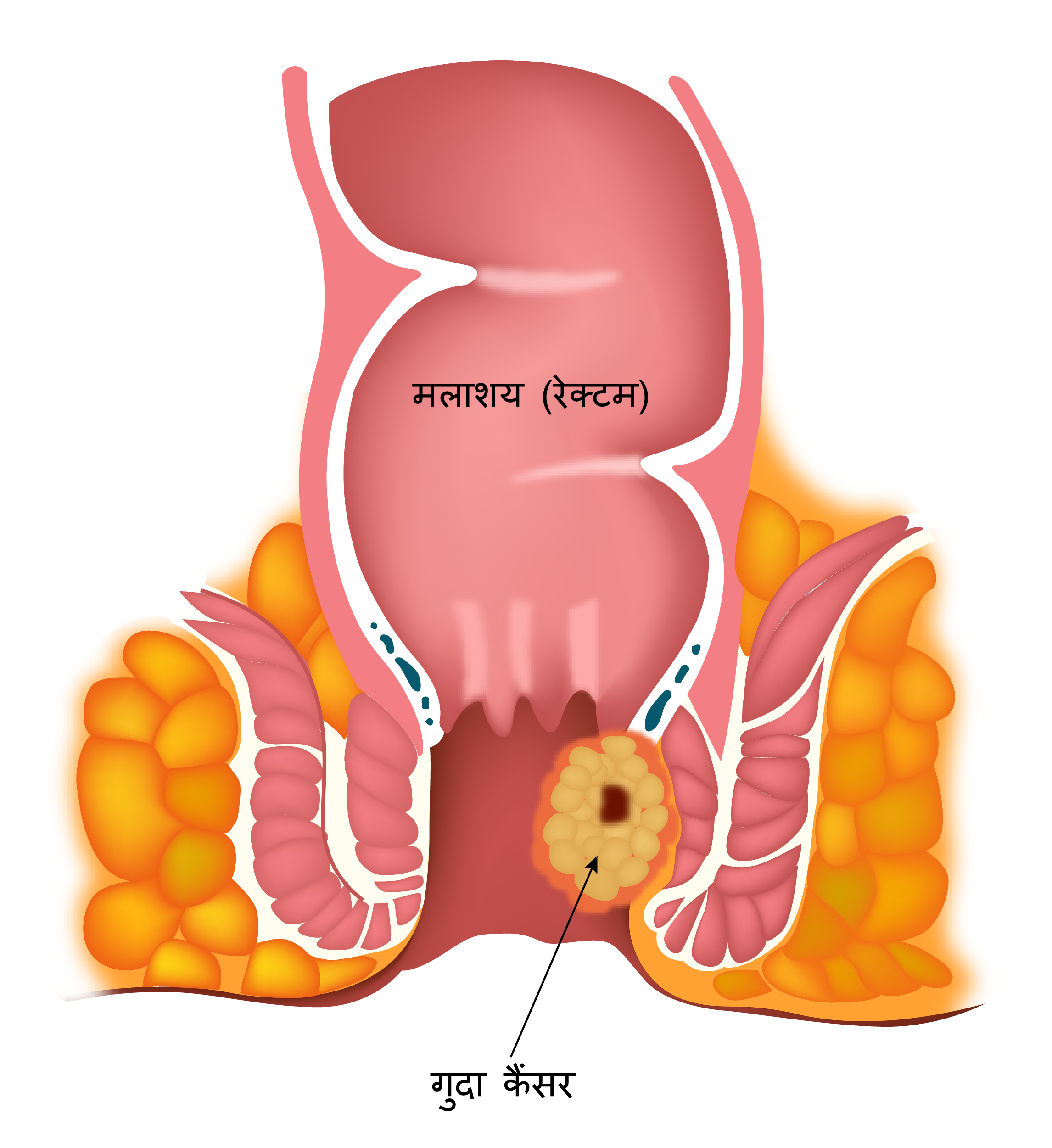 anal cancer 2-01