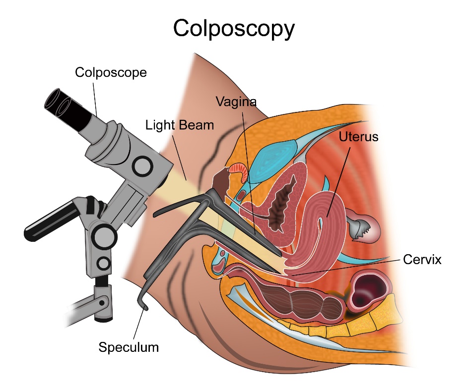 Can I Have Sex Before A Colposcopy Exclusive Telegram Link